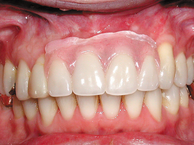 Implant Supported Partial Dentures Austin Dentist Mike Williamson