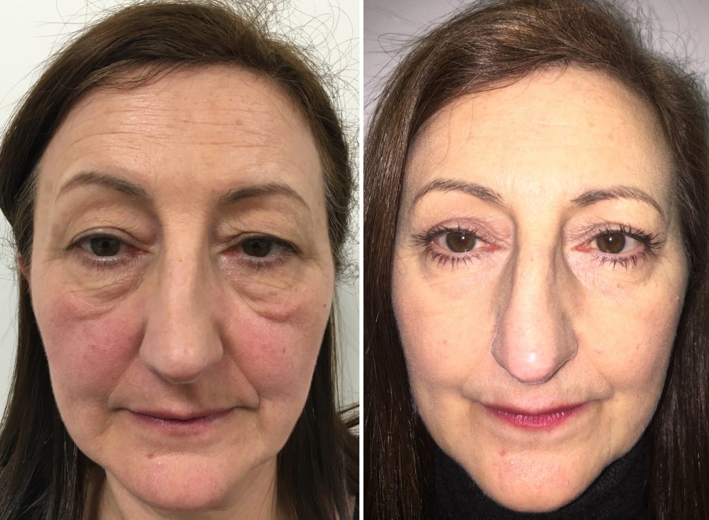 How Much For Eye Bag Removal Surgery Uk Bitty Bag