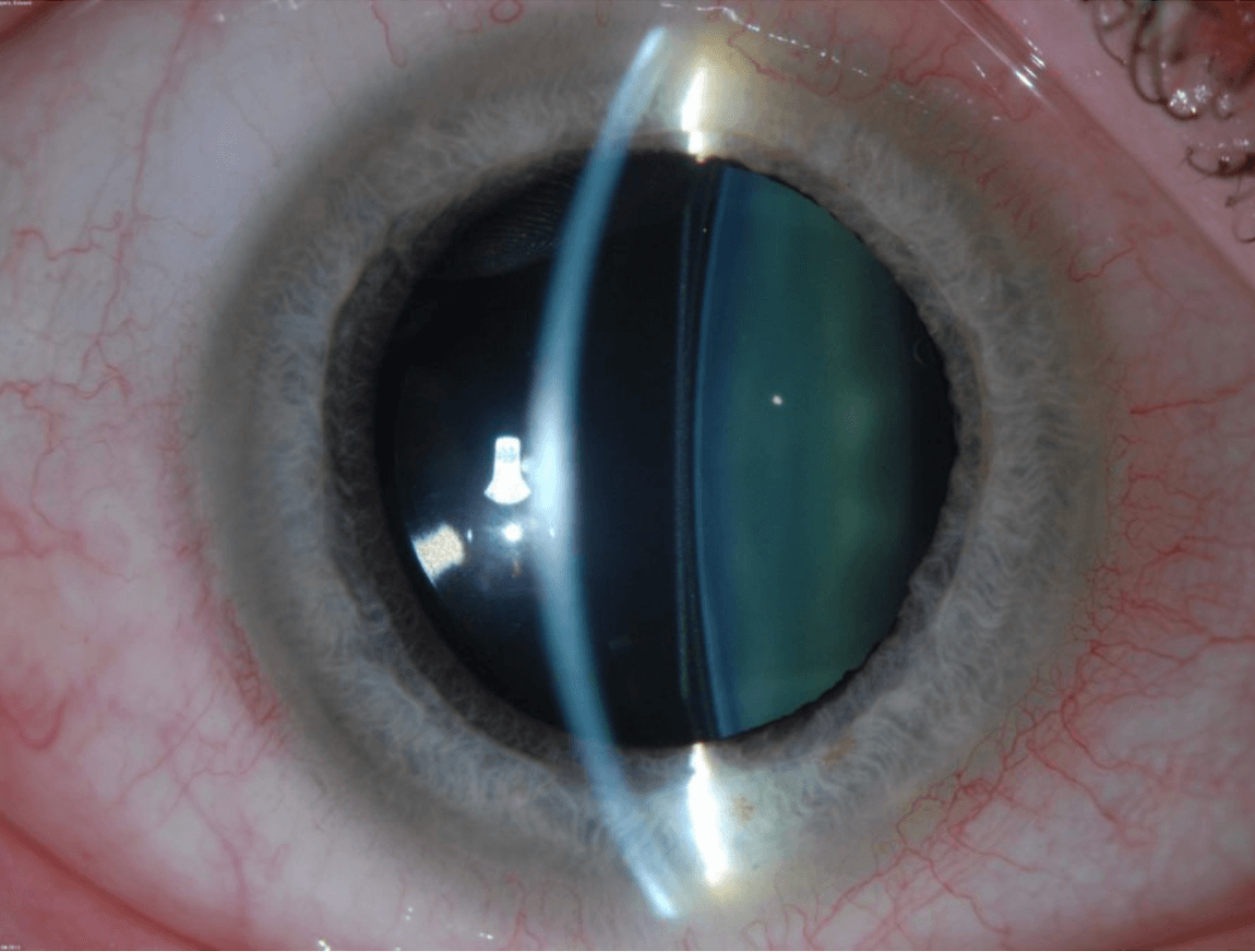 Implantable Collamer Lens (ICL) Surgery Wills Eye Hospital