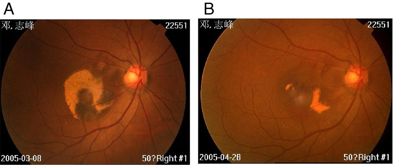 Macular Degeneration Breakthrough Study Wise Choice Medicine