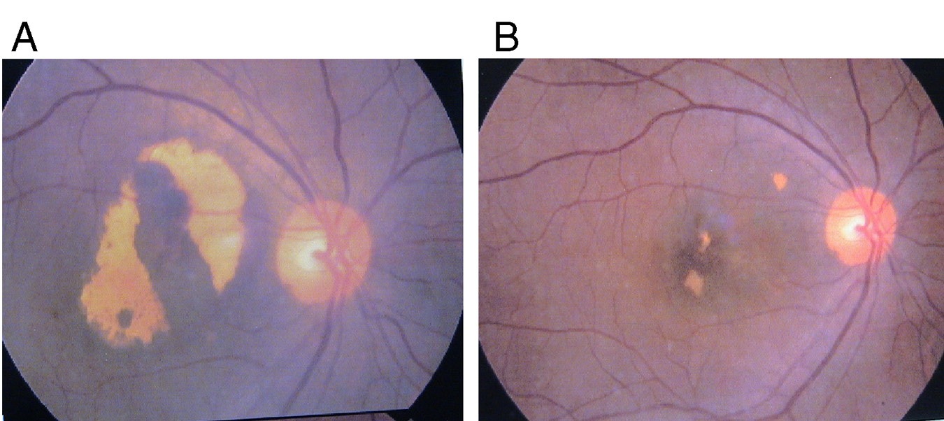 Macular Degeneration Breakthrough Study Wise Choice Medicine