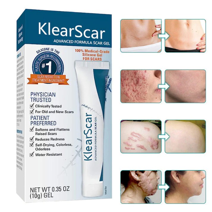 KlearScar™ Advanced scar removal gel Wizzgoo Shop