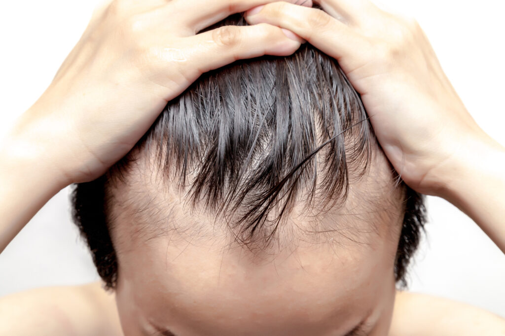 The Benefits of ARTAS Robotic Hair Restoration Woman of Style and