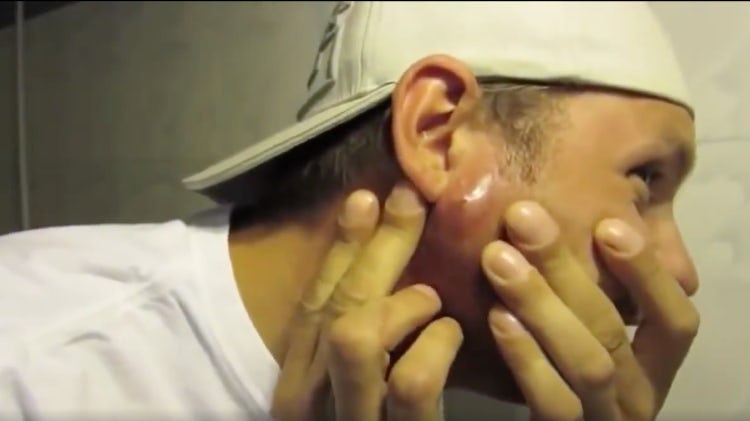 This Guy Popped a Really Old Pimple and Honestly Today Is Canceled