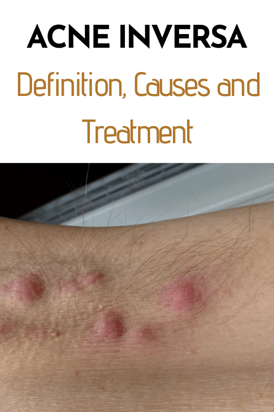 Acne Inversa (Hidradenitis Suppurativa) Definition, Causes and Treatment
