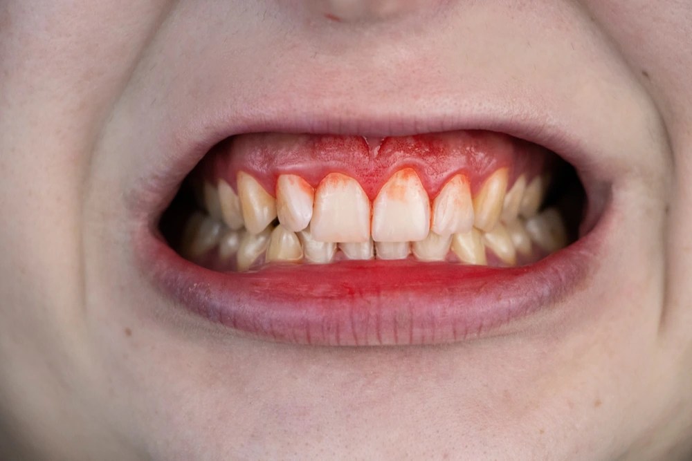 Understanding Bleeding Gums Why Do My Gums Bleed