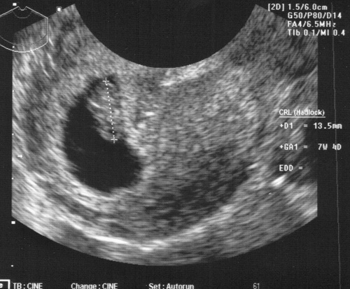 7 Weeks Pregnant Symptoms Week by Week Pregnancy Calendar