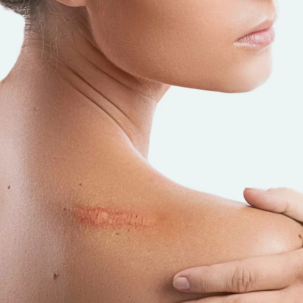 SCAR TREATMENT - Dr Wang Yi Shi - W Skin And Laser Clinic