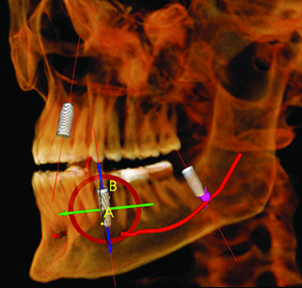 Dental Implants Waterbury CT