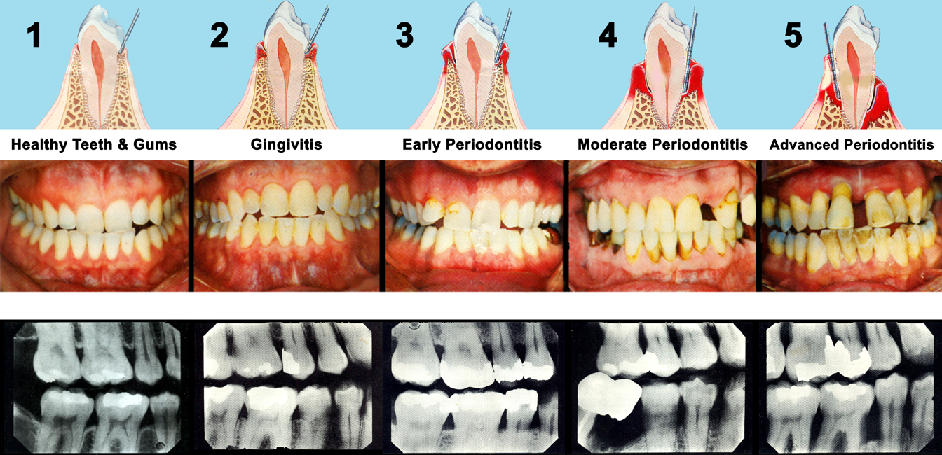 Periodontal Disease Waterbury CT