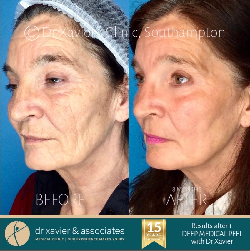 Phenol Peels (Deep Peels) for deep wrinkles Southampton Hampshire