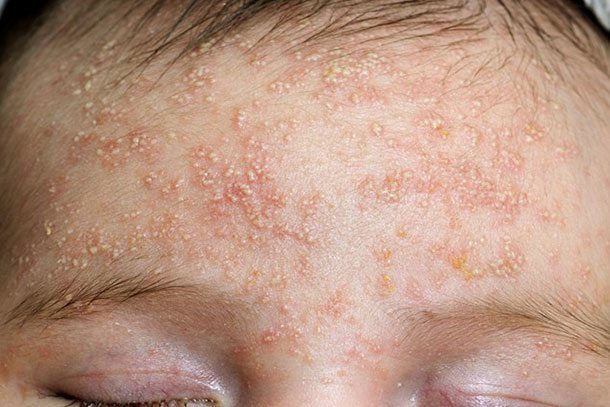How To Get Rid of Heat Bumps on skin Yabibo
