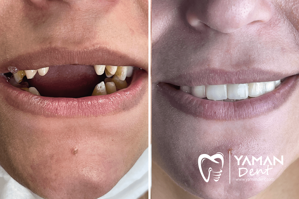 Smile Design in Turkey Prices and Procedures Yaman Dent