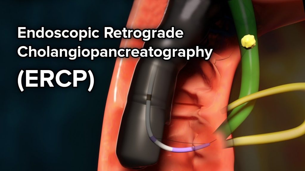 Endoscopic Retrograde CholangioPancreatography (ERCP) Yashoda Hospital