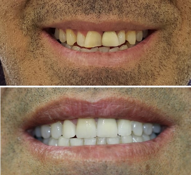 Dental Implants Jerusalem Dr Yoav Orbach your dentist in Jerusalem