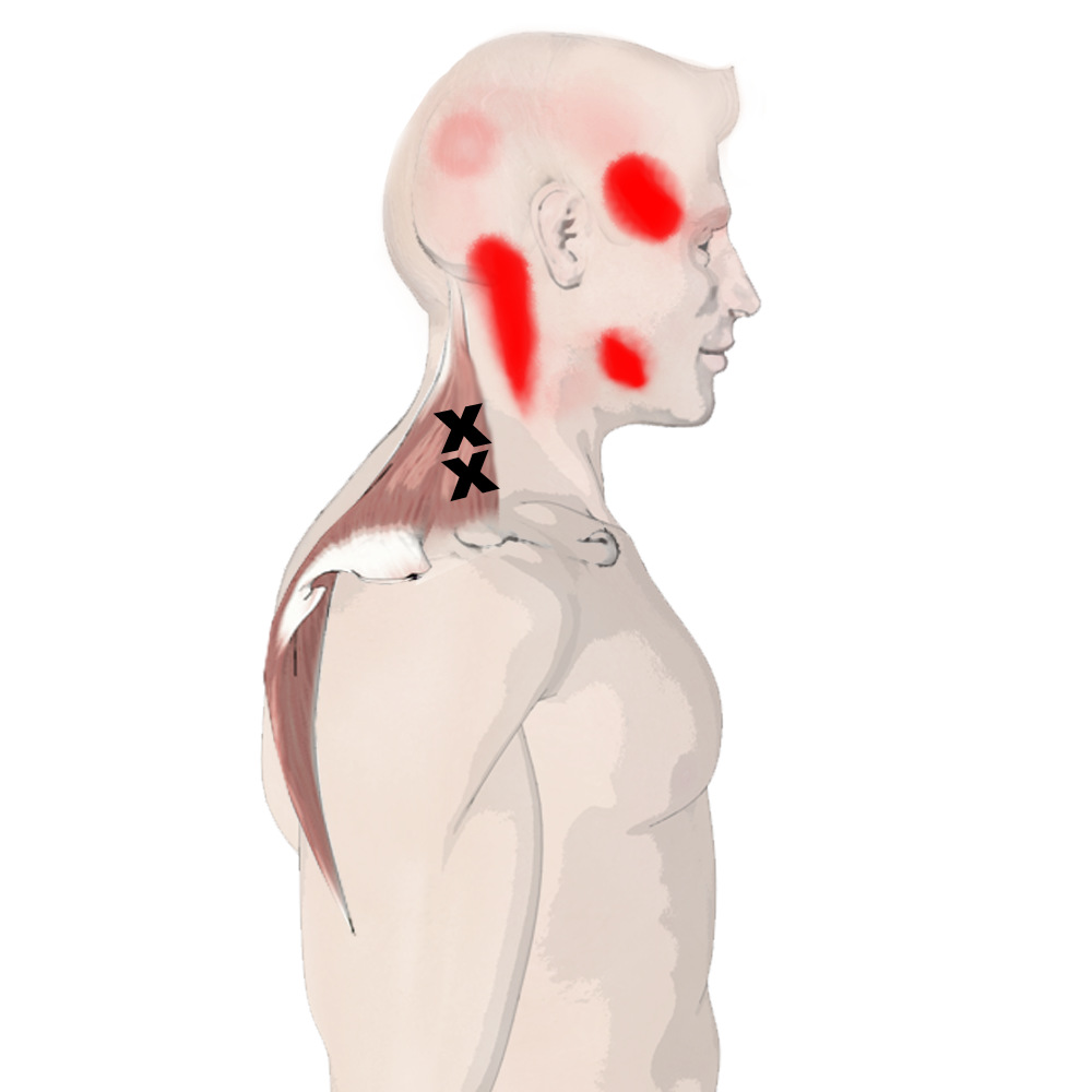 The Trapezius Muscle, Its Attachments And Actions Yoganatomy