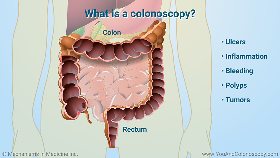 Slide Show What happens during and after a colonoscopy?