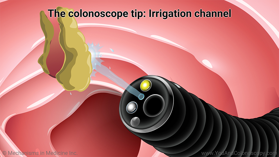 Slide Show What happens during and after a colonoscopy?