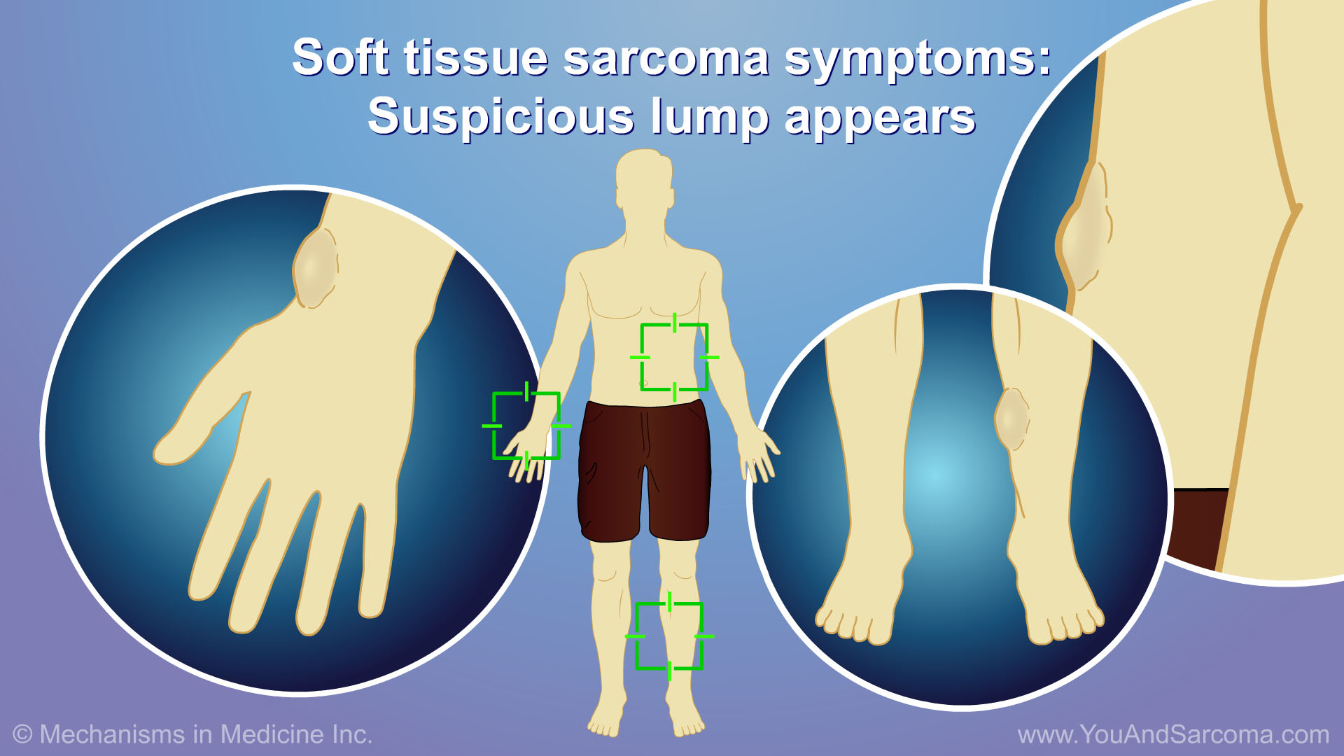 Diagnosing and Treating Soft Tissue