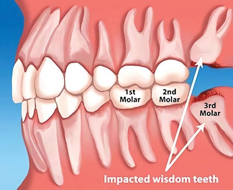 Wisdom Tooth Removal Fremont, CA Your Caring Dentist