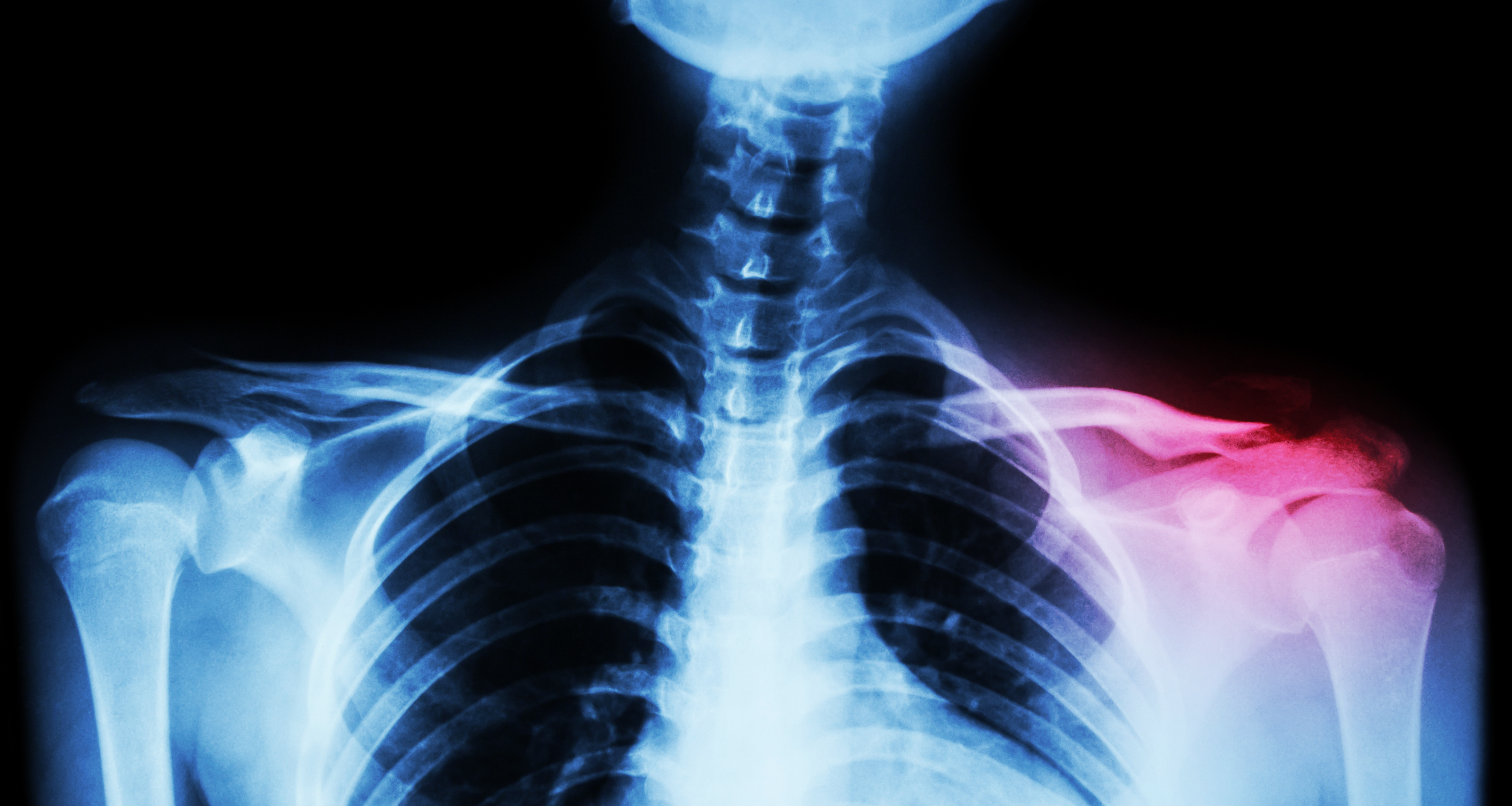 distal clavicular osteolysis Columbia Advanced Chiropractic, LLC