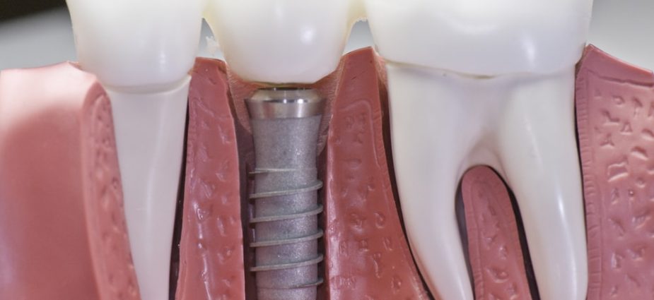 Dental Implants Implant Types, Treatment and Recovery Guide