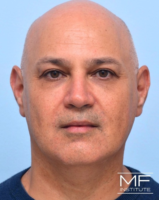 Under Eye Filler / Midface Rejuvenation in the San Francisco Bay Area