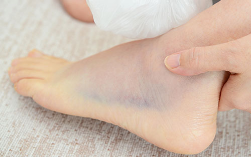 Is It OK to Walk on a Sprained Ankle