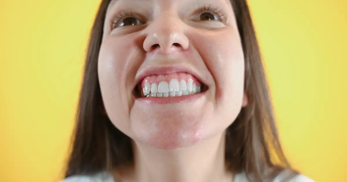What You Need to Know About Gummy Smile? Zenit Dent
