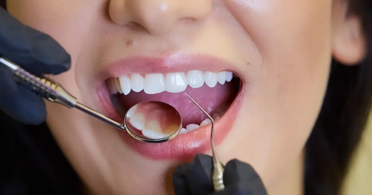 Veneers vs Implants Which are Better? Zenit Dent