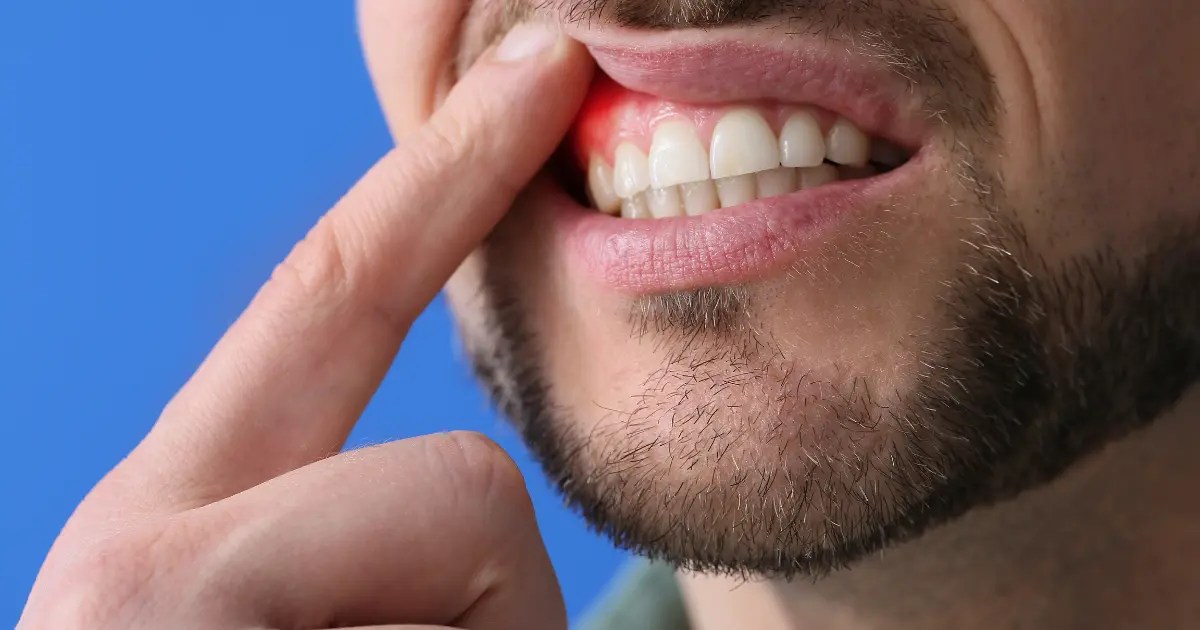 Gingivectomy Procedure, Risks and Benefits Zenit Dent