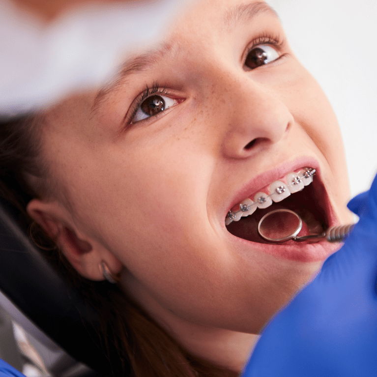 Braces Fixing Zenith Dentistry