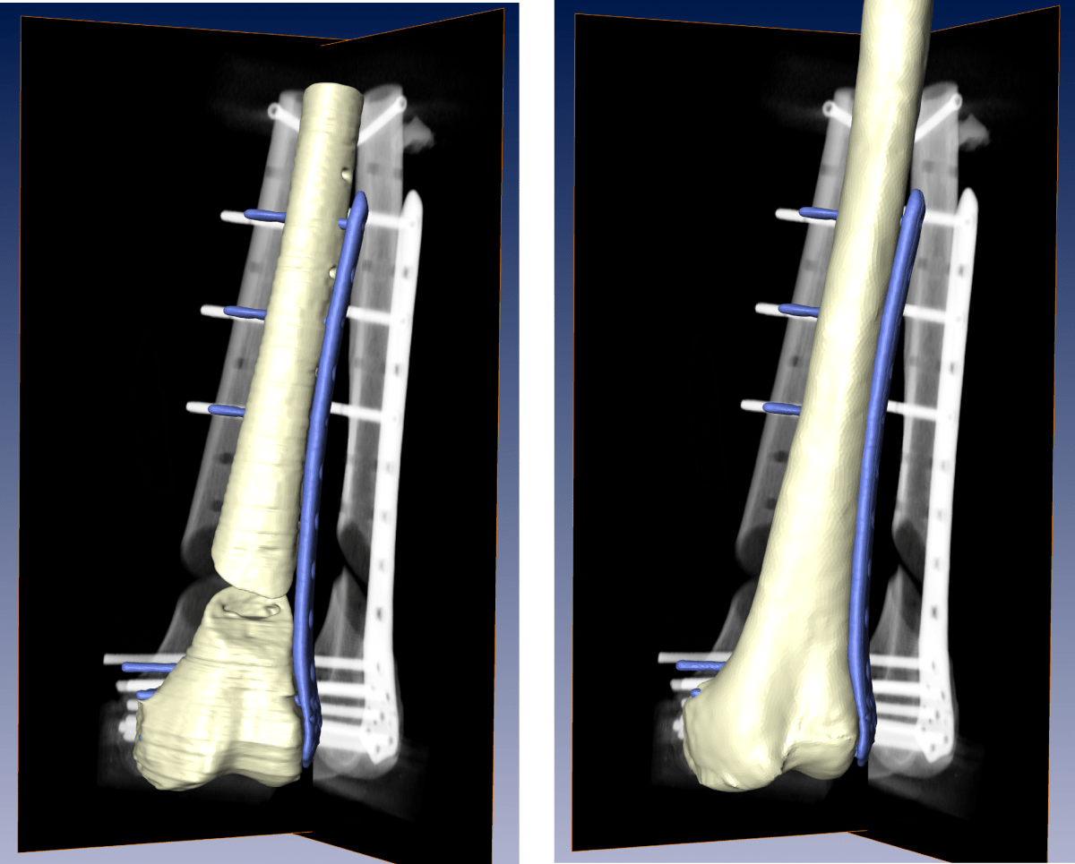 Osteosynthesis Followup from 2D Xrays Zuse Institute Berlin (ZIB)