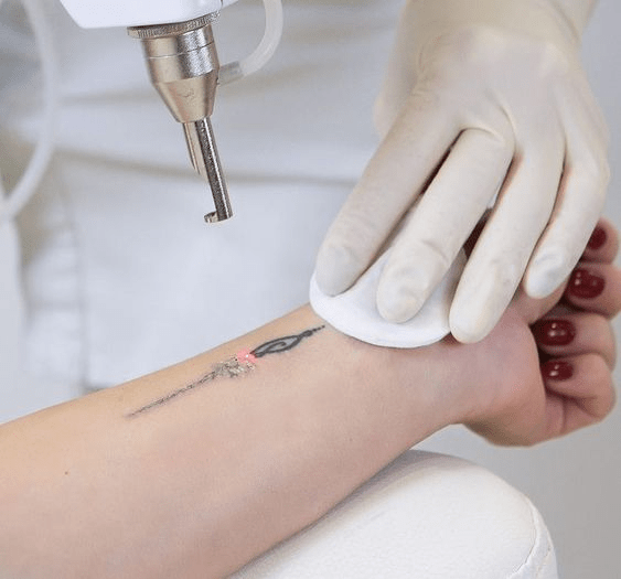 Laser Tattoo Removal Zo Skin Centre