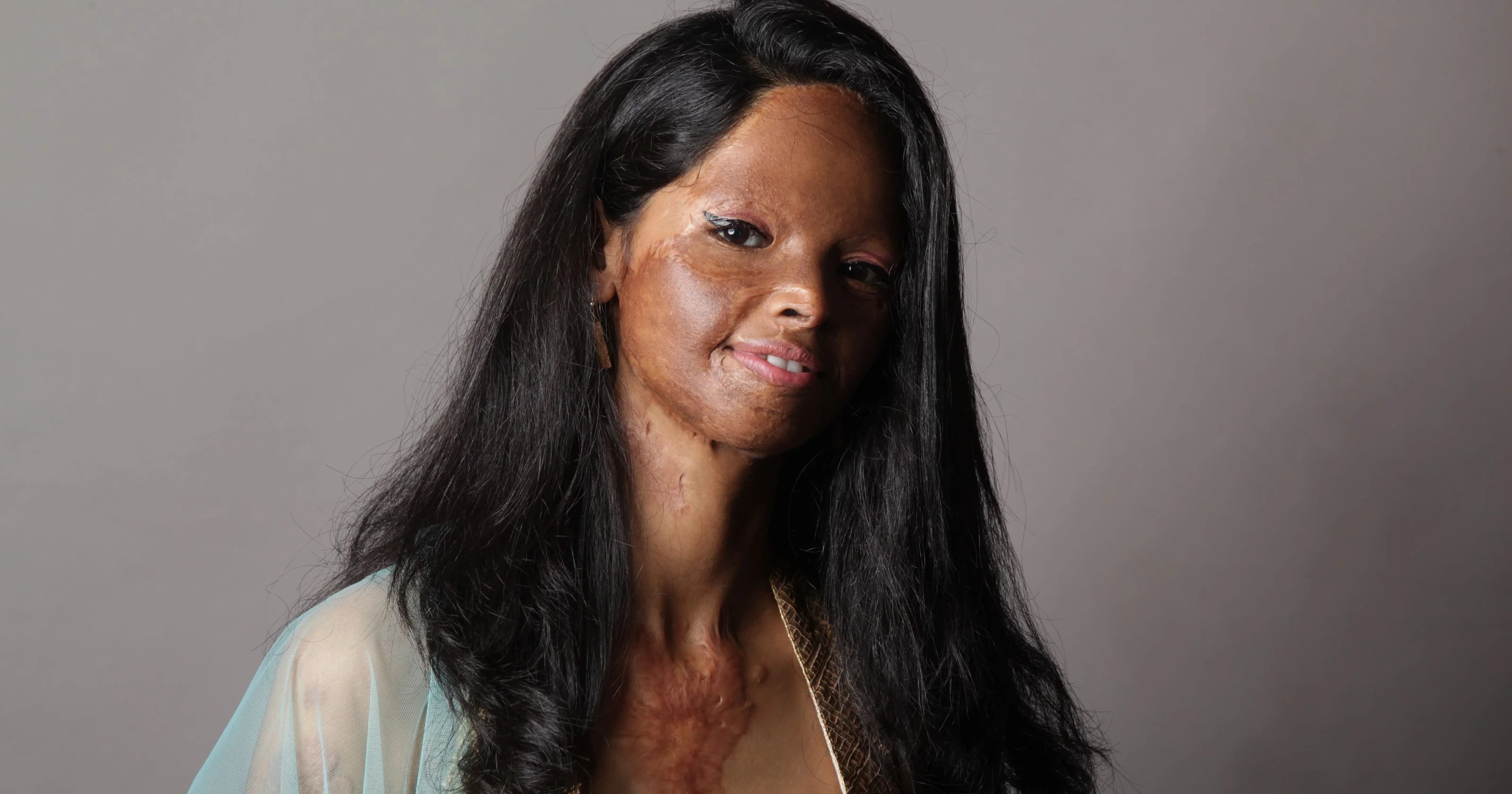 Some patients may need reconstructive burn surgery after the initial burn wounds have healed. Plastic Surgery Provides Hope For Acid Attack Survivors
