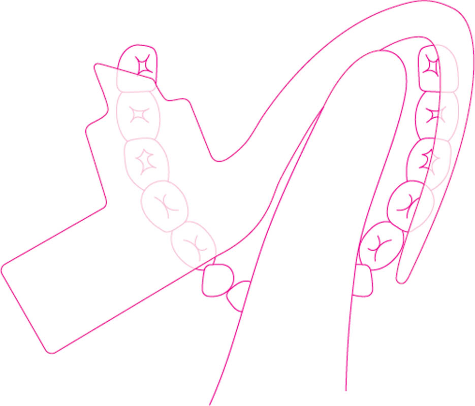 Isolite Mouthpiece Sizing and Placement Zyris Makers of the Isolite