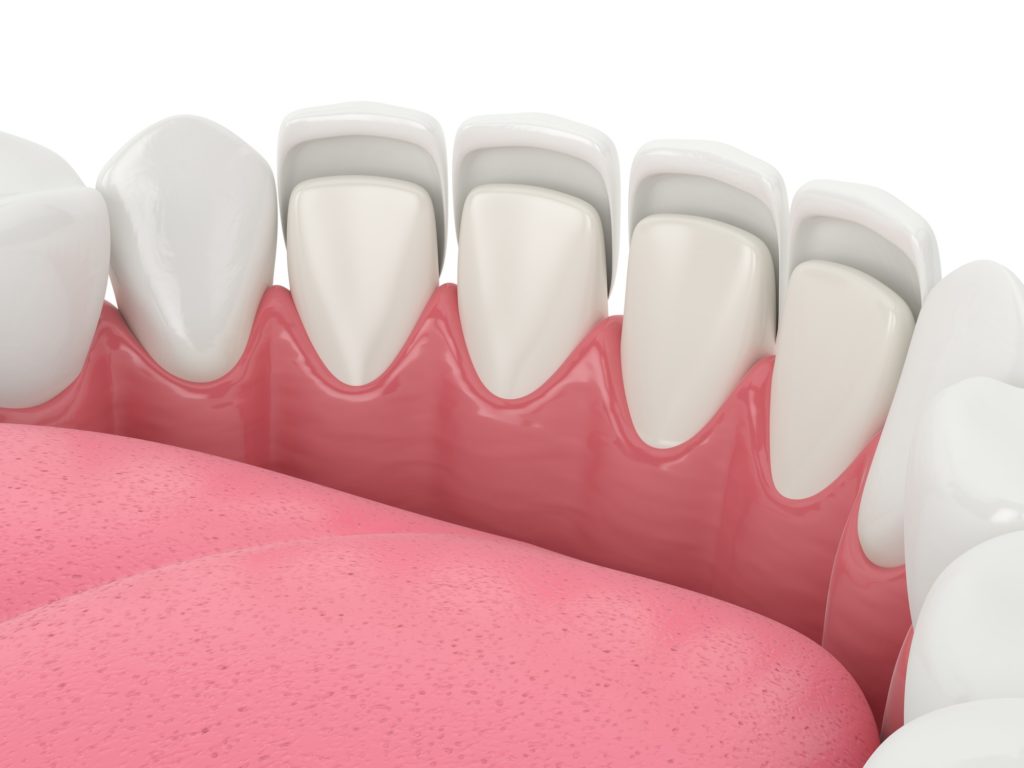 Dental Bridges What is a Dental Bridge, Procedure & Benefits?