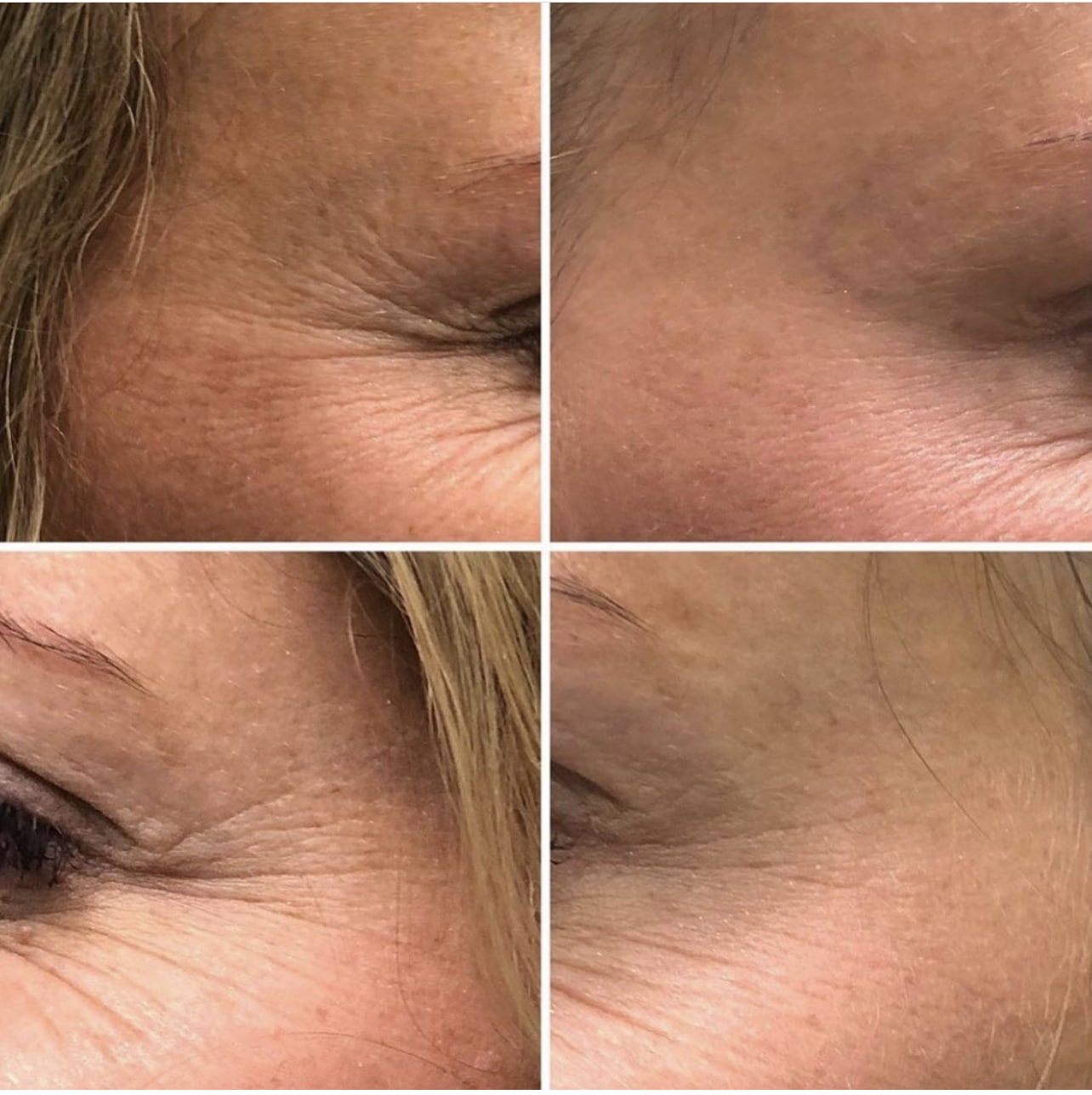 Before and After Wymore Laser