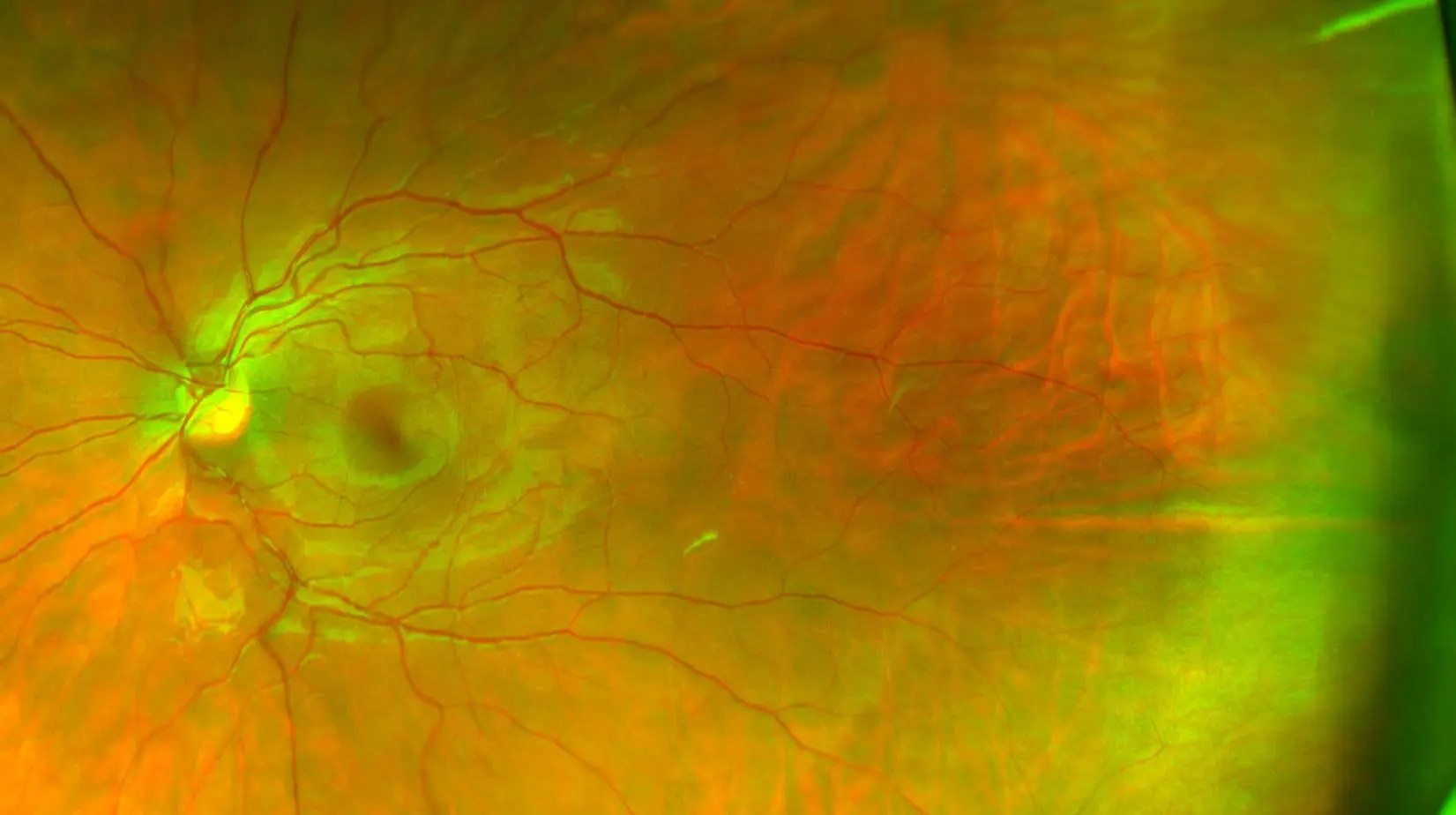 Headache After Eye Exam Dilation Cluster Headaches
