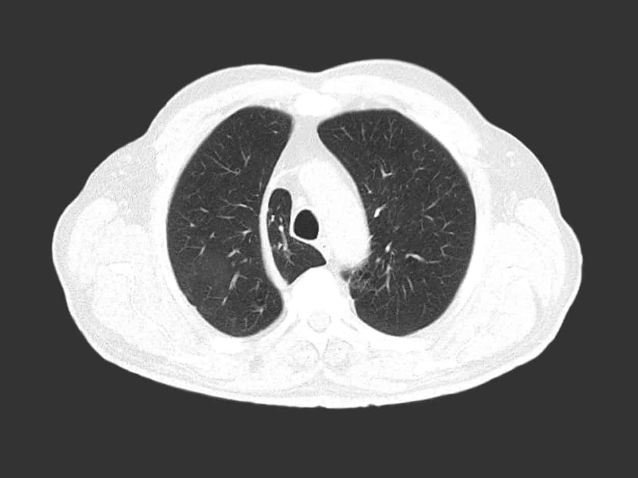 Chest CT Insight Medical Imaging