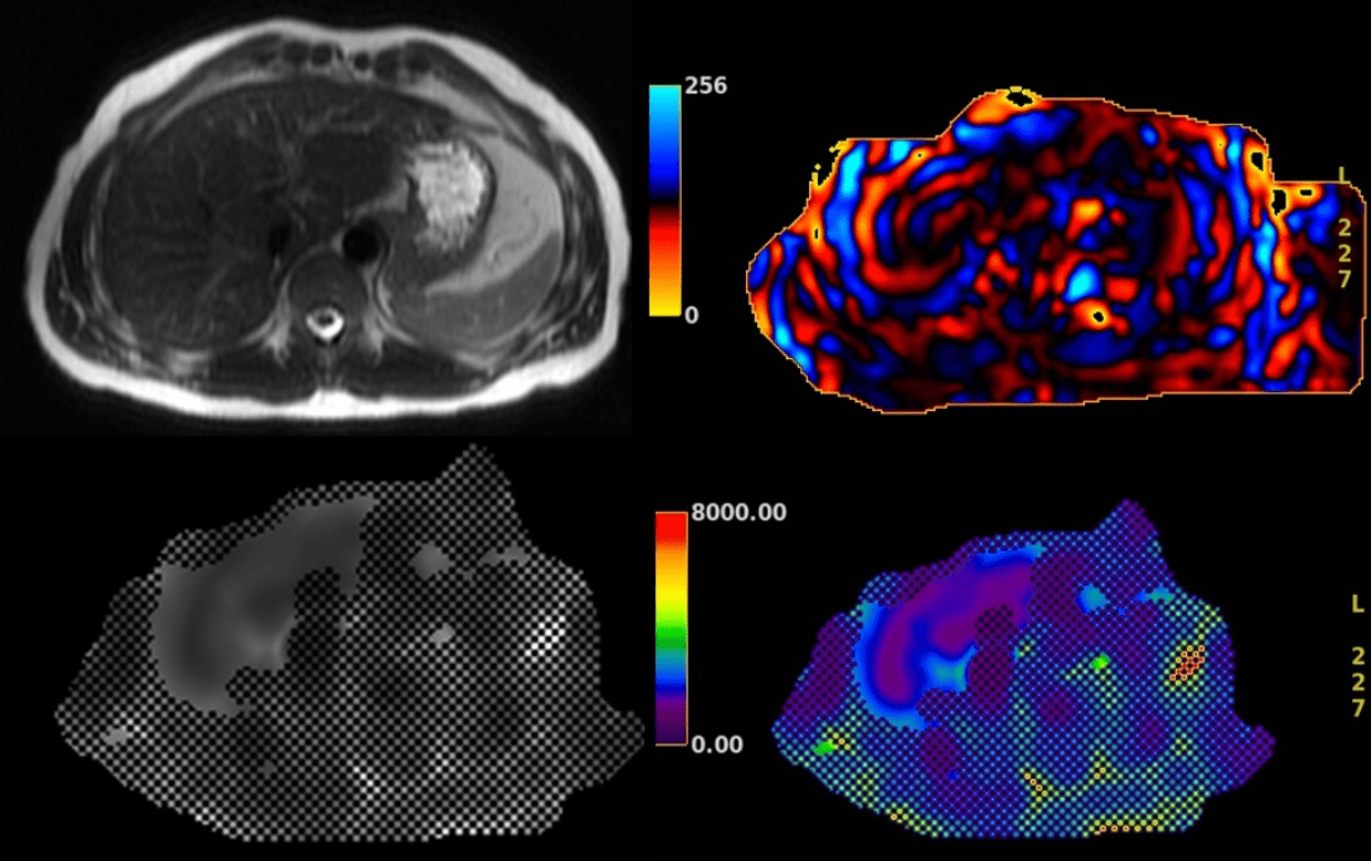 Liver Elastography MRI in Edmonton and Around Alberta Insight Medical
