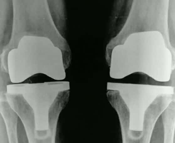 two knee replacements at once