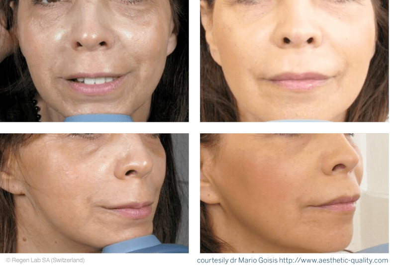 PLATELET RICH PLASMA (PRP) TREATMENT Xeoul Clinic