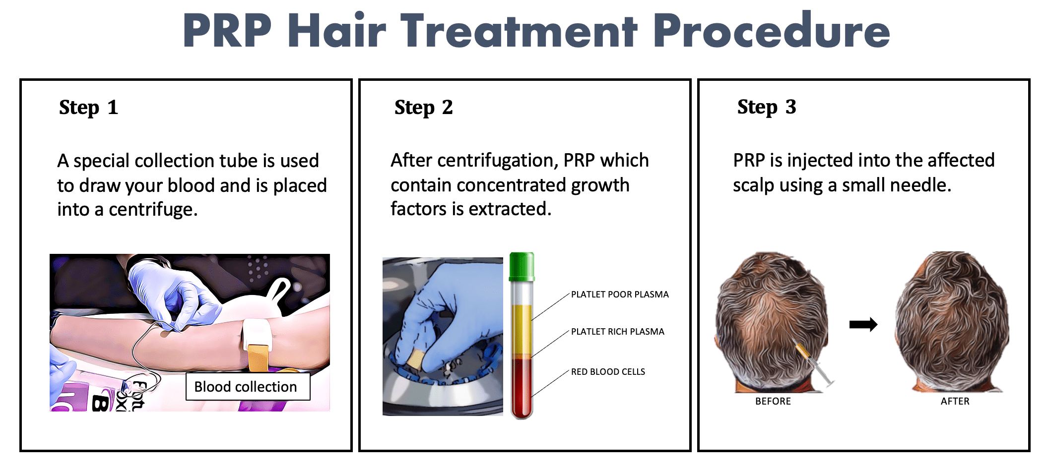 PRP Hair Loss Treatment Xeoul Clinic