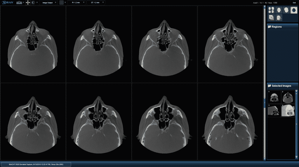 MiniCAT 2020 CT Scanner for ENT & Allergy Physicians