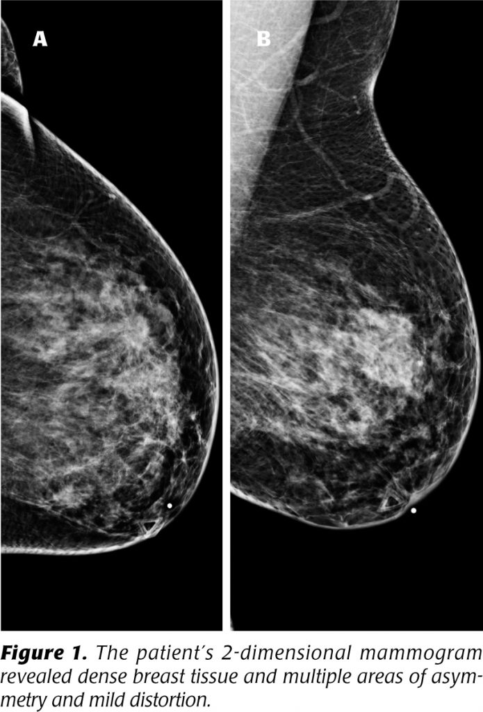 Tomosynthesis, Definitive image for improved breast cancer diagnosis