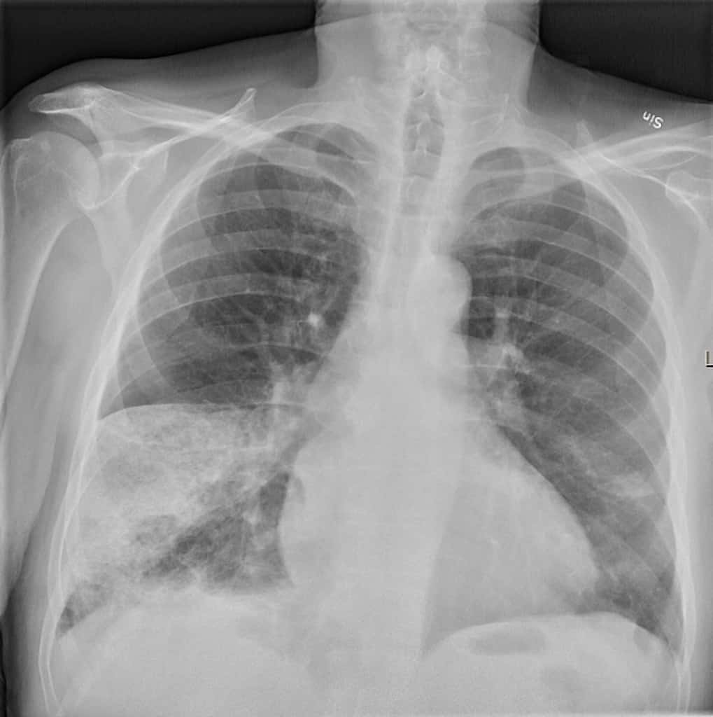 Nhồi máu phổi Ca lâm sàng