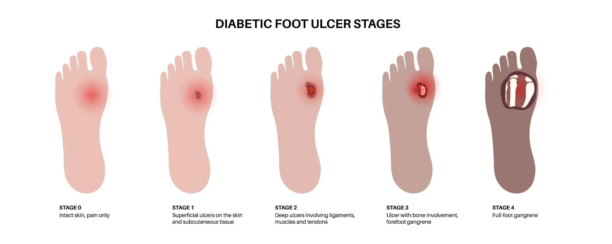 Understanding and Treating Diabetic Foot Ulcers A Guide to Healing