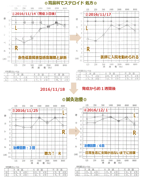 低音 障害 型 感 音 性 難聴 急性低音障害型感音難聴の体験談【ストレスと寝不足に注意】