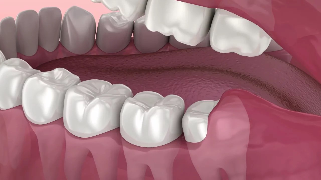 Wisdom Teeth Removal Yonge Forest Dental Dental Clinic in Barrie